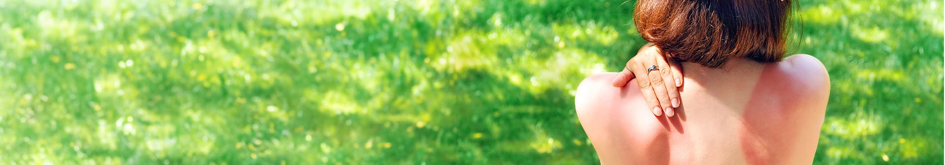Rimedi Efficaci e Creme da Usare per le Scottature Solari 1 1