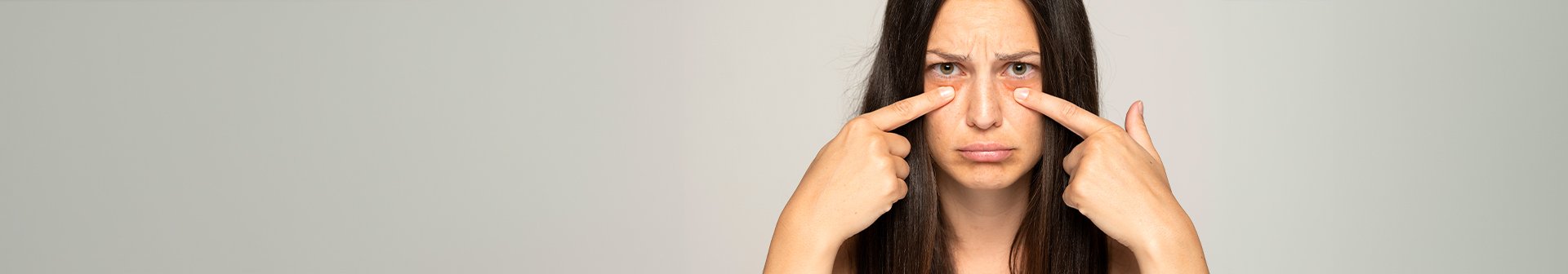 Cause e 3 Rimedi Efficaci per Ridurre le Occhiaie