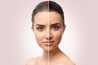 I 4 Rimedi Efficaci Contro I Brufoli Garnier