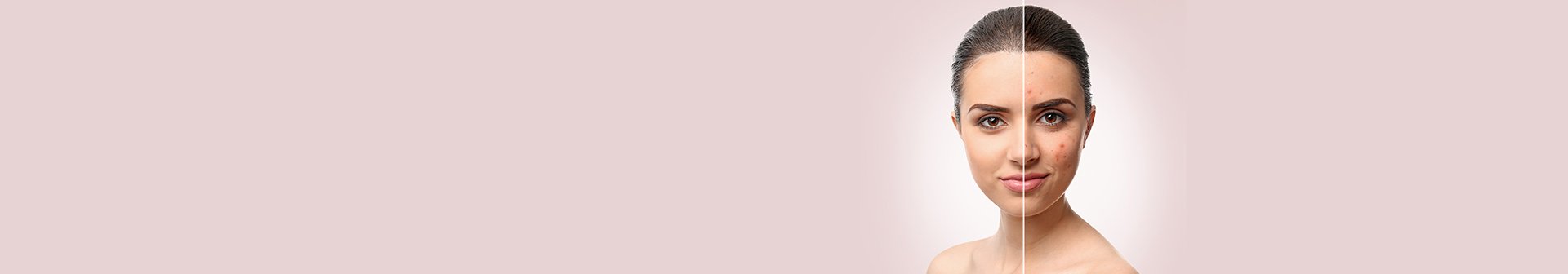 ragazza con il viso a metà: prima e dopo i rimedi contro i brufoli