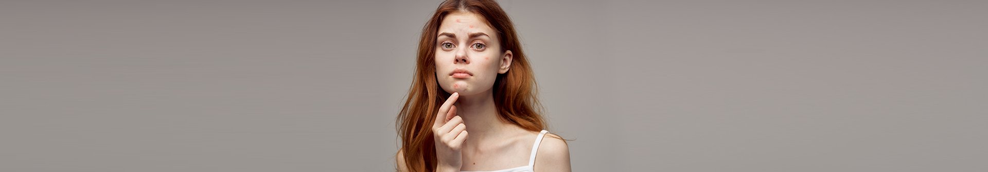 ragazza con brufoli sul viso