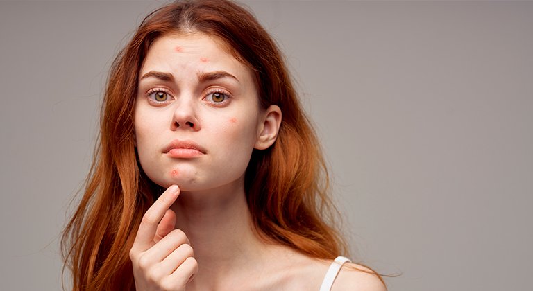 ragazza si indica brufoli sul viso