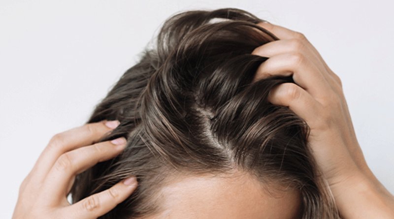 Cause e Rimedi Efficaci per i Capelli Unti ed Oleosi-1
