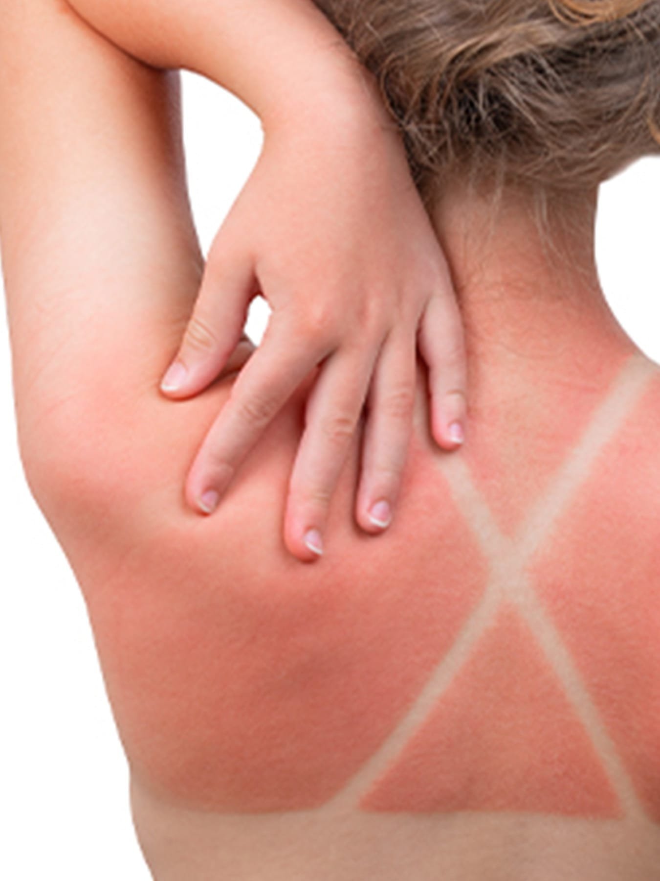 Come-prevenire-le-scottature-solari_search